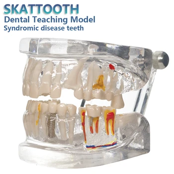 Модель зубного имплантата Патологические Зубы Демонстрационная модель зубов Прозрачные Зубы для стоматологов Исследование патологии полости рта Обучение
