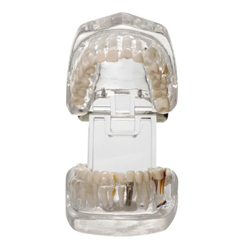 Модель зубного имплантата Патологические Зубы Демонстрационная модель зубов Прозрачные Зубы для стоматологов Исследование патологии полости рта Обучение Изображение 2
