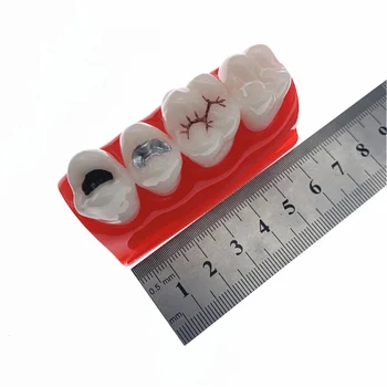 Модель стоматологического кабинета для герметизации ям и трещин, модель для лечения зубов