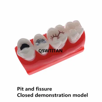 Модель стоматологического кабинета для герметизации ям и трещин, модель для лечения зубов Изображение 2